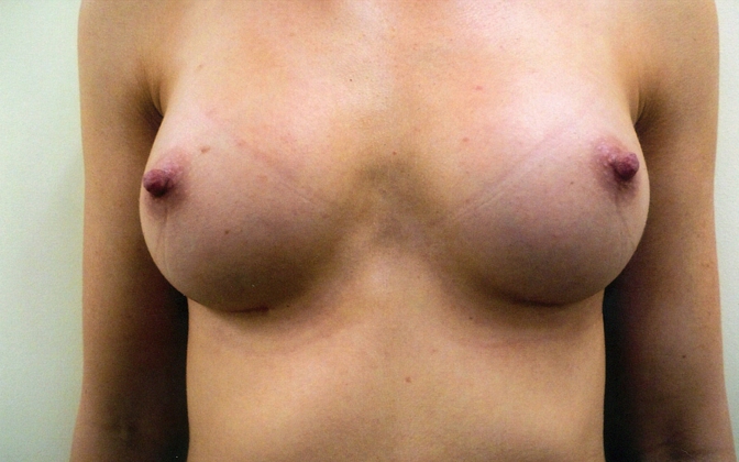 After Procedure