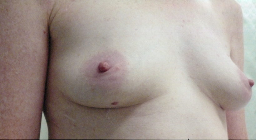 Before Procedure