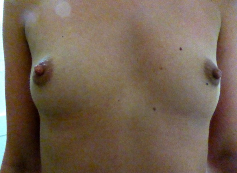 Before Procedure