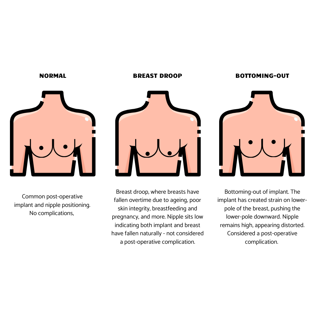 Why Do Nipples Point Down After Breast Augmentation Surgery?