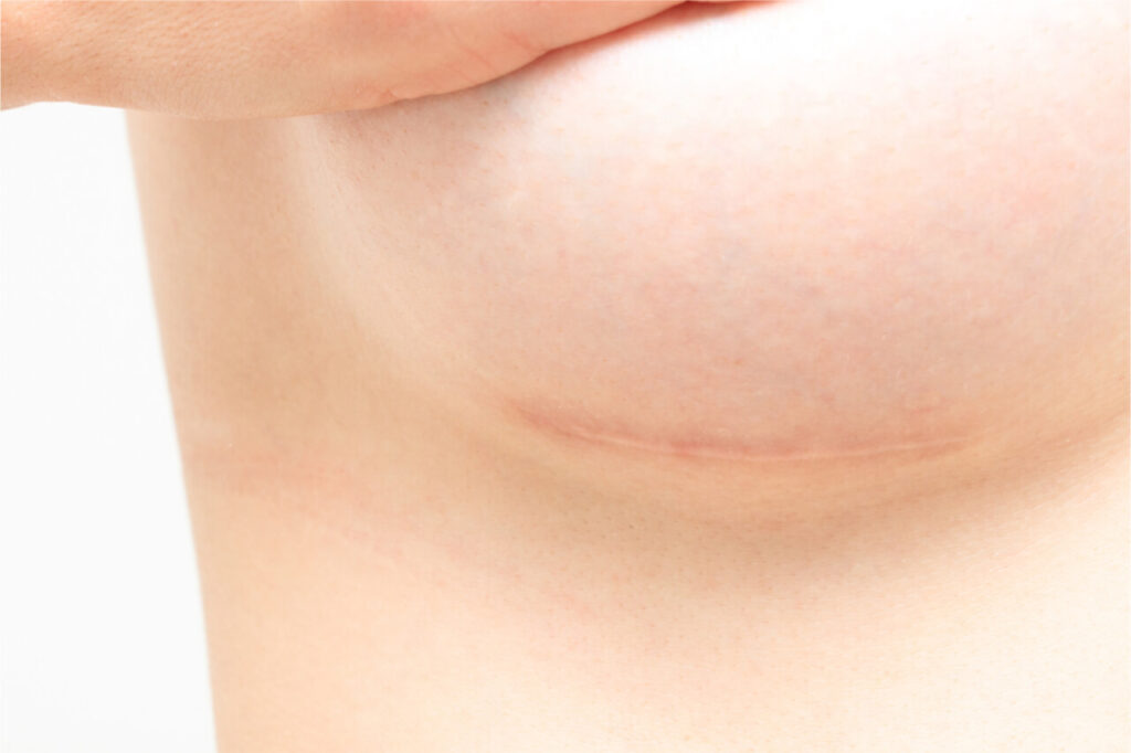 Breast Lift Mastopexy Scars & Breast Augmentation Mammoplasty