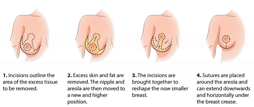 Breast Reduction Recovery Process: Week by Week - Raadina Health