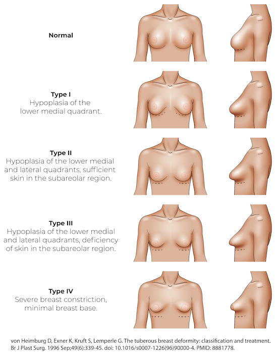 What It's Like to Have Tuberous Breast Deformity
