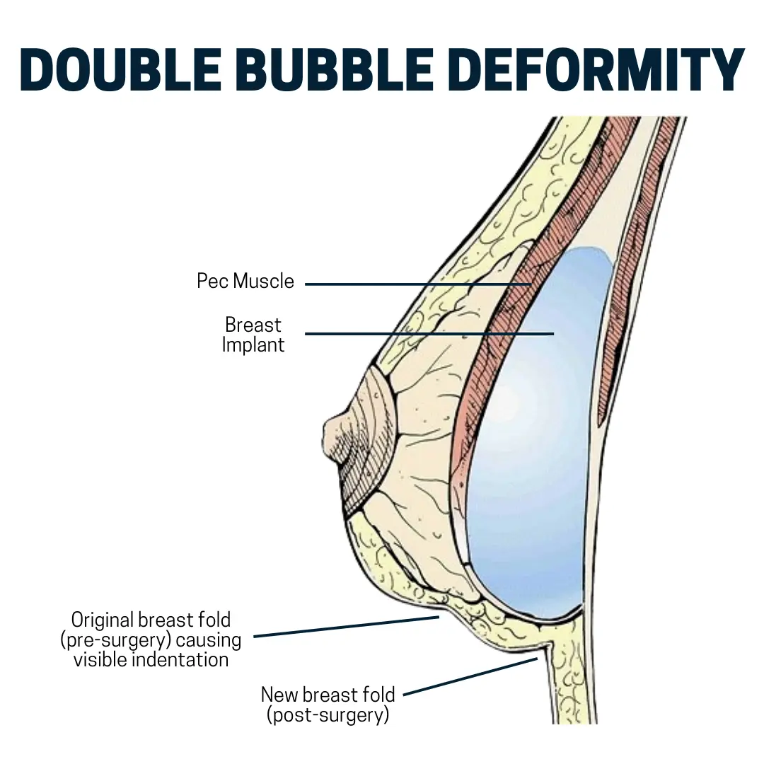 What is Double Bubble Implant and How Do You Fix It?